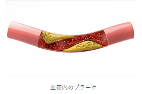 血管内のプラーク